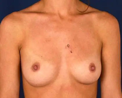 Breast Augmentation