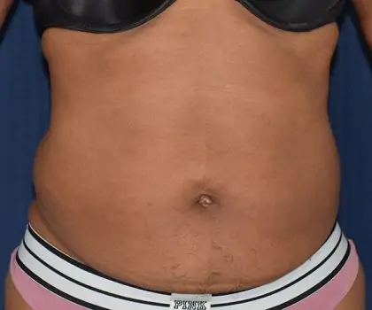 Liposuction