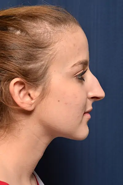 Rhinoplasty