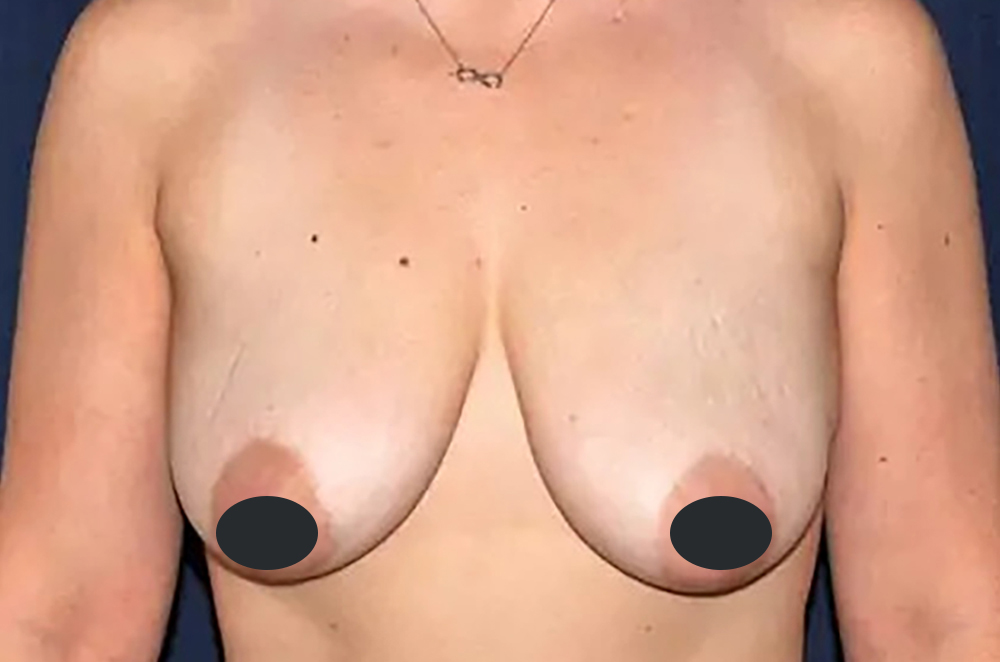 Breast Augmentation with Lift