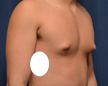 Gynecomastia