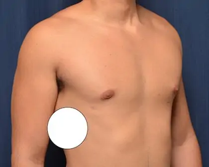 Gynecomastia