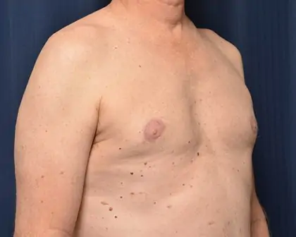 Gynecomastia