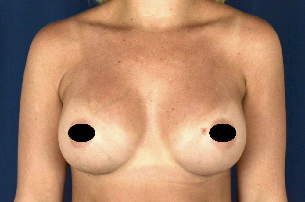 Breast Augmentation