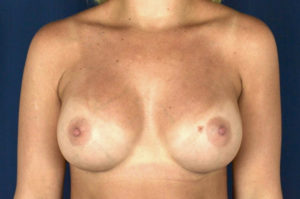 Le Spa Plastic Surgery Before and After Photos
