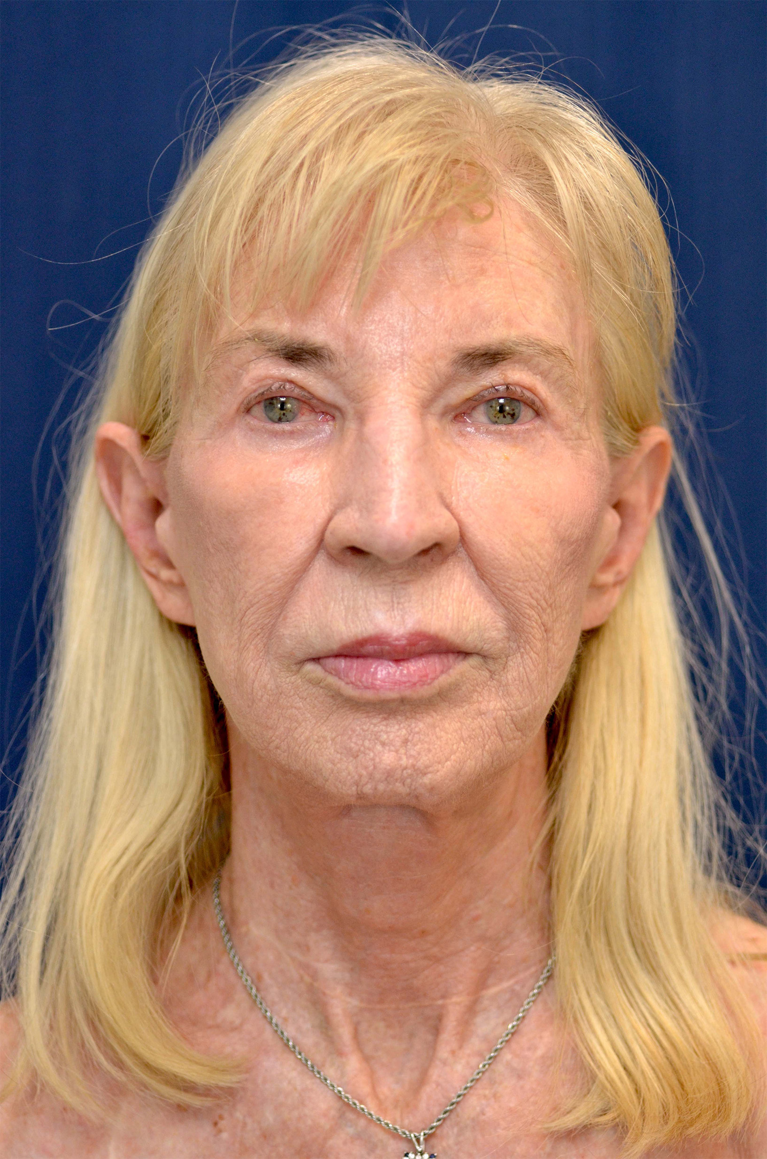 Facelift / Neck Lift