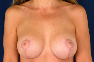 Le Spa Plastic Surgery Before and After Photos