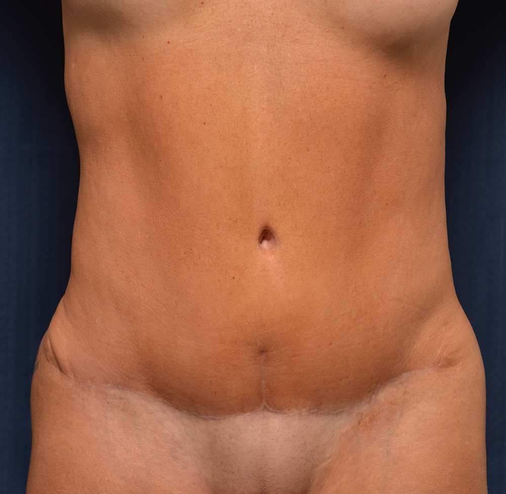 Tummy Tuck