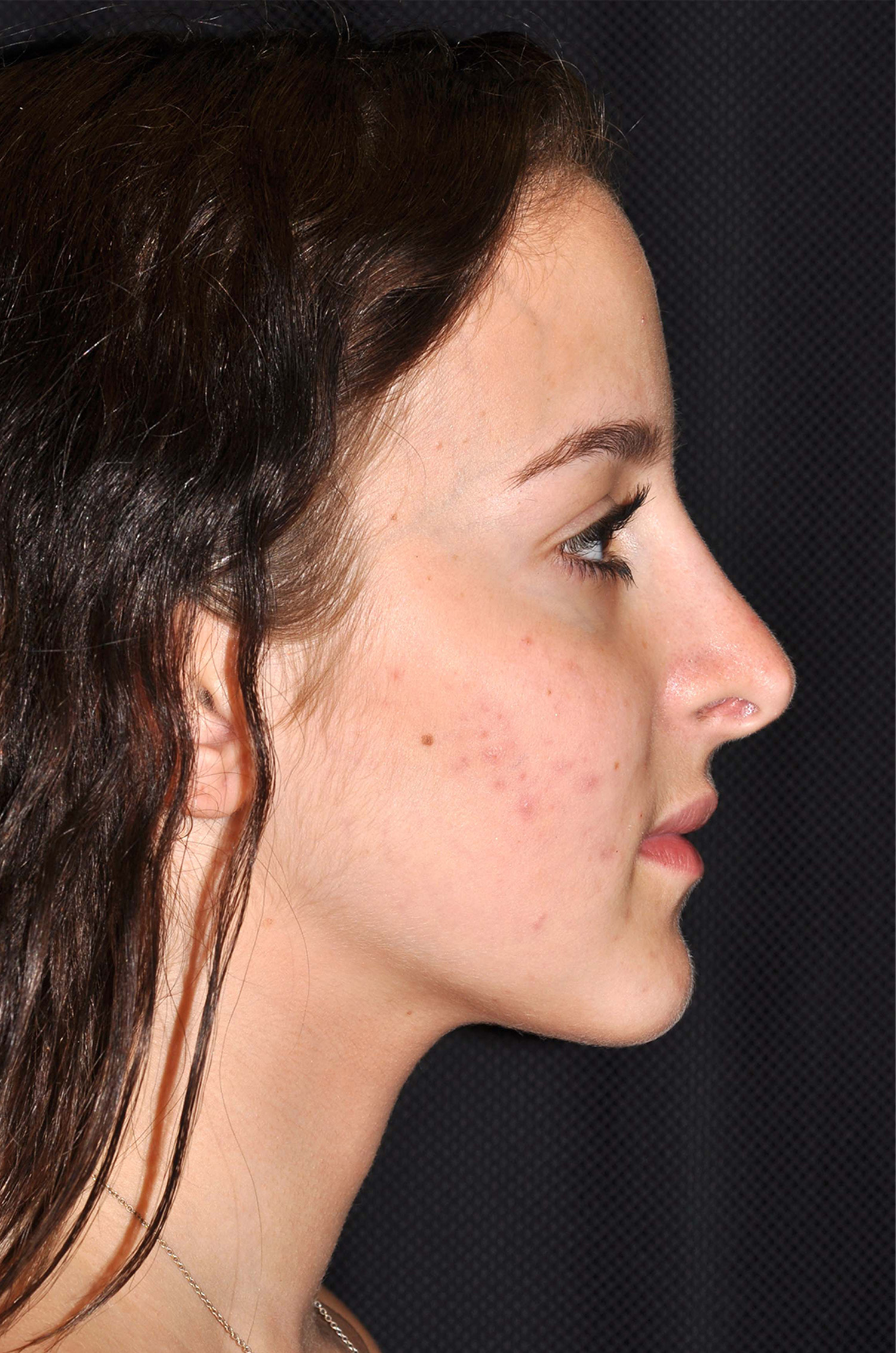 Rhinoplasty