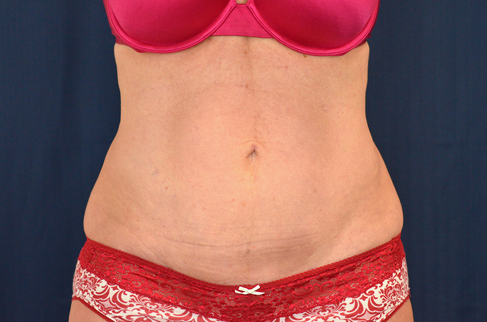 Tummy Tuck
