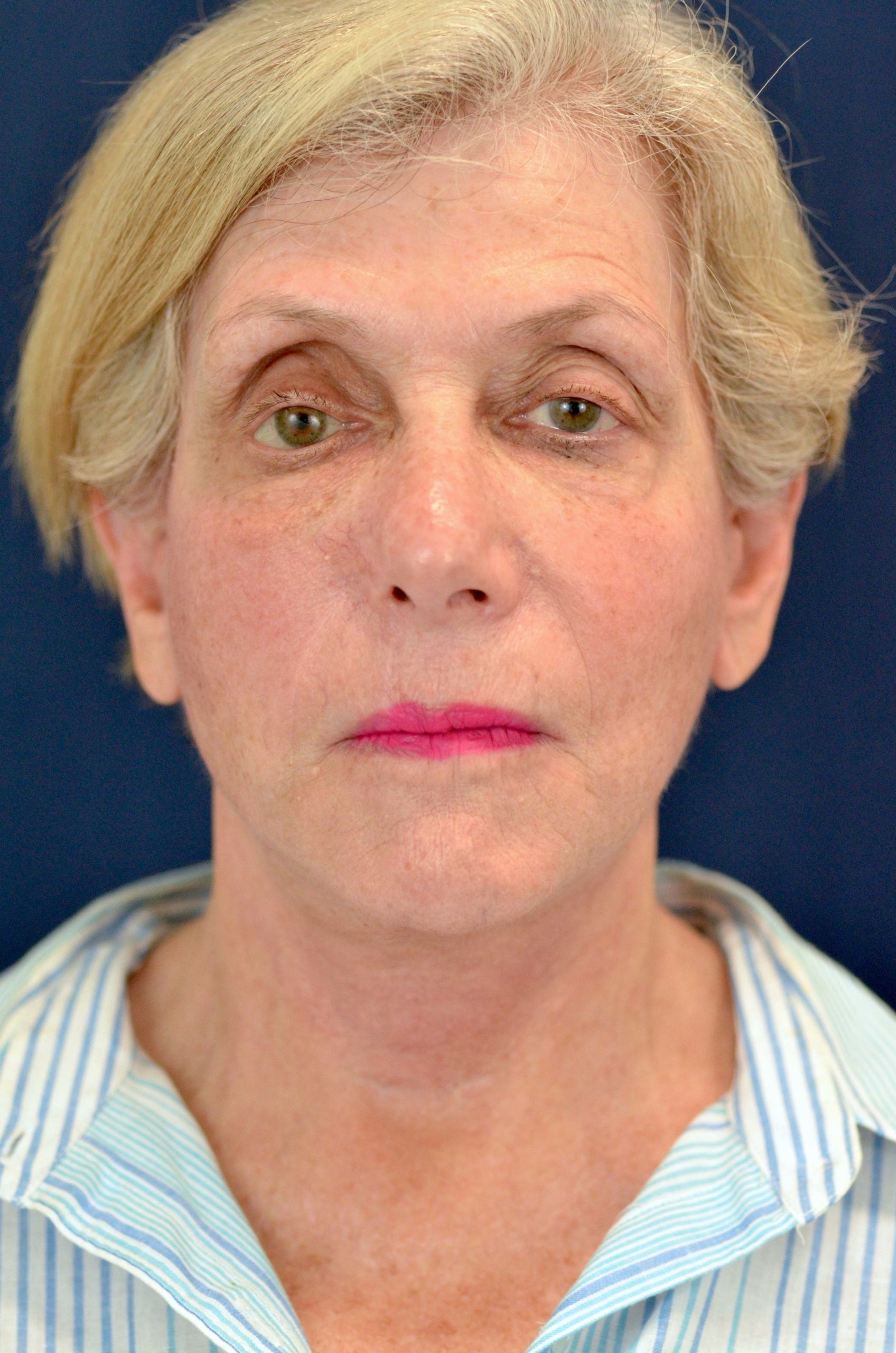 Facelift / Neck Lift