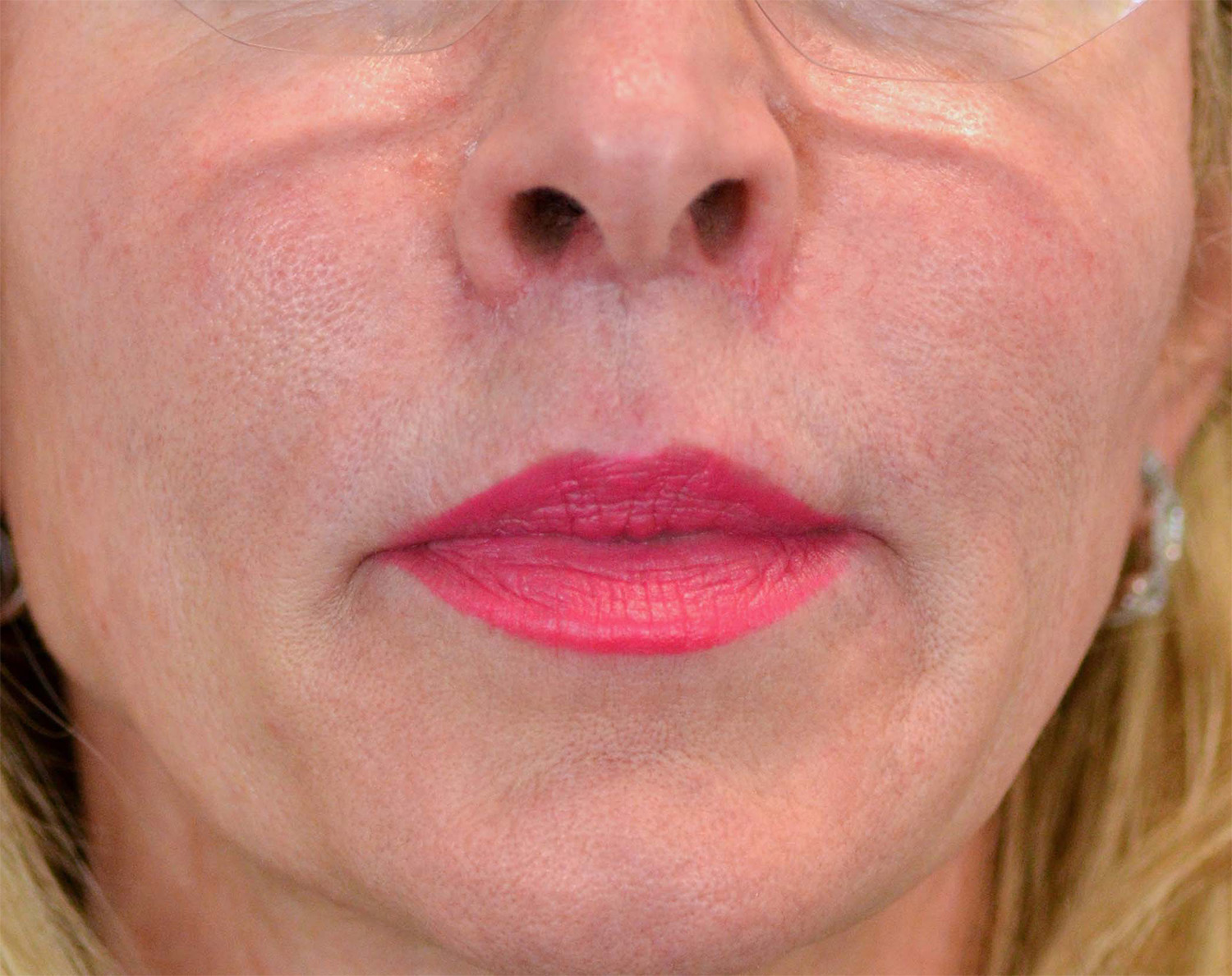 Lip Augmentation / Lip Lift