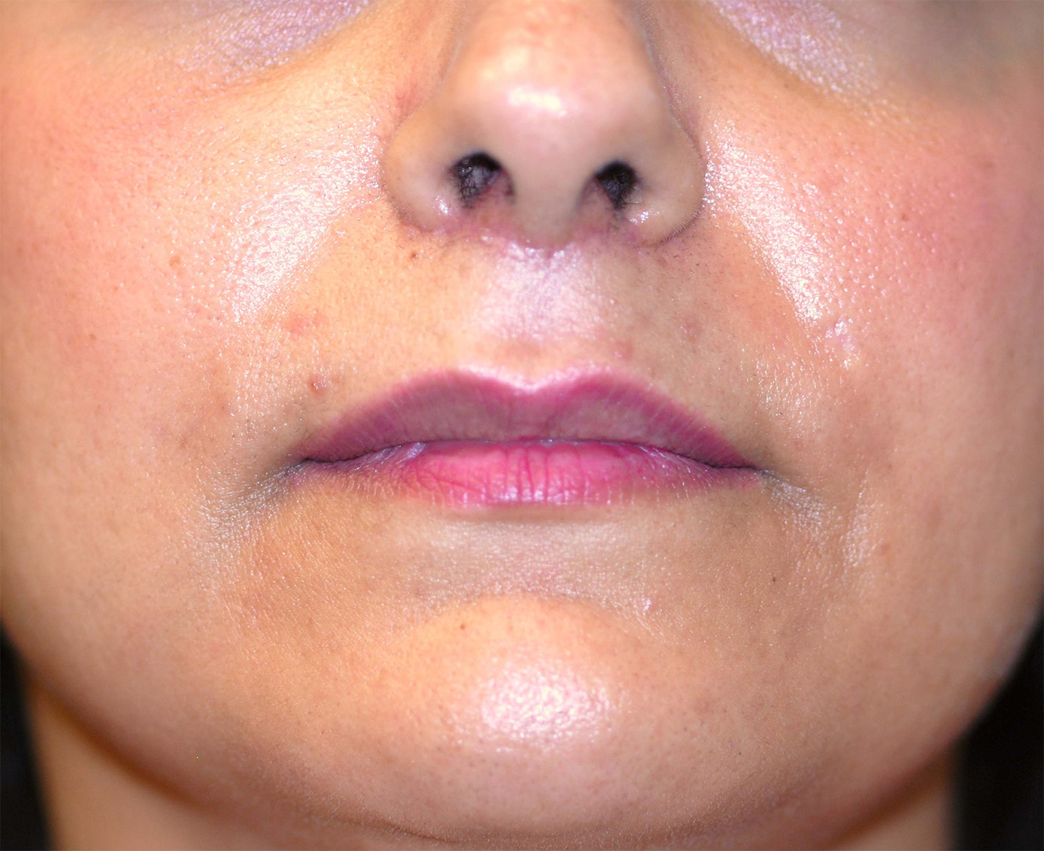 Lip Augmentation / Lip Lift