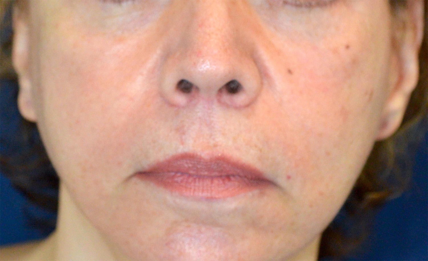 Lip Augmentation / Lip Lift