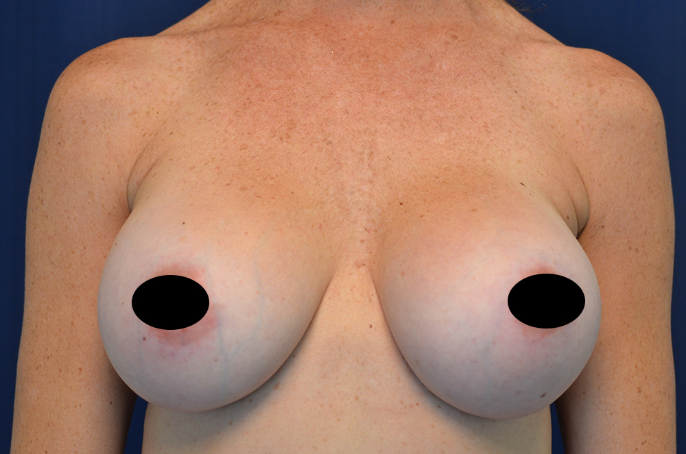 Breast Implant Revision