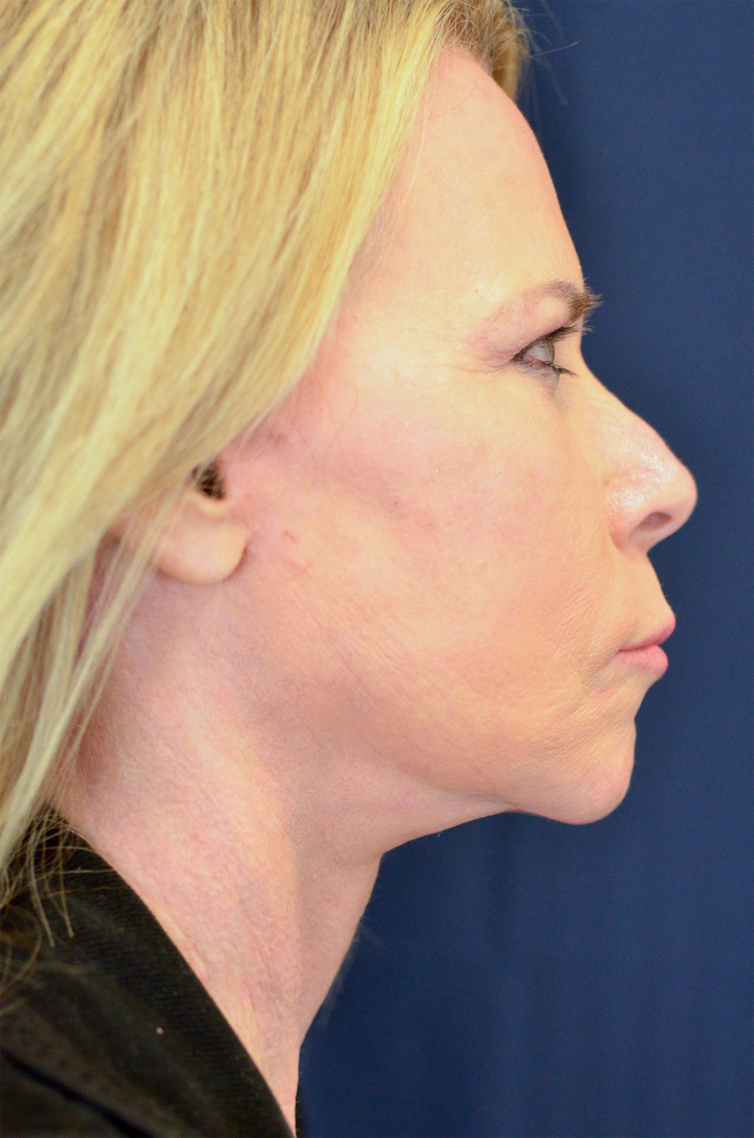 Facelift / Neck Lift