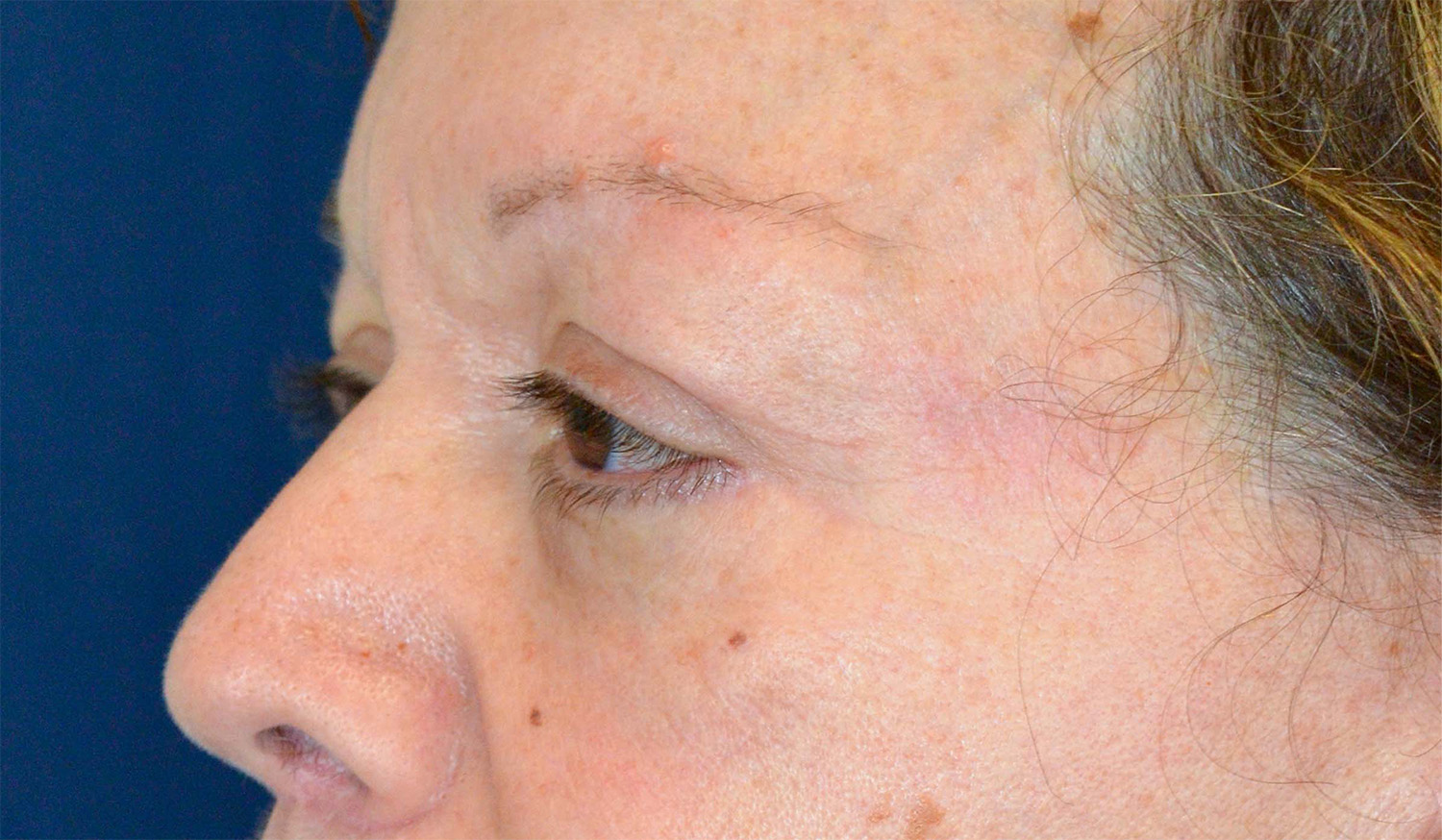 Eyelid Lift / Brow Lift