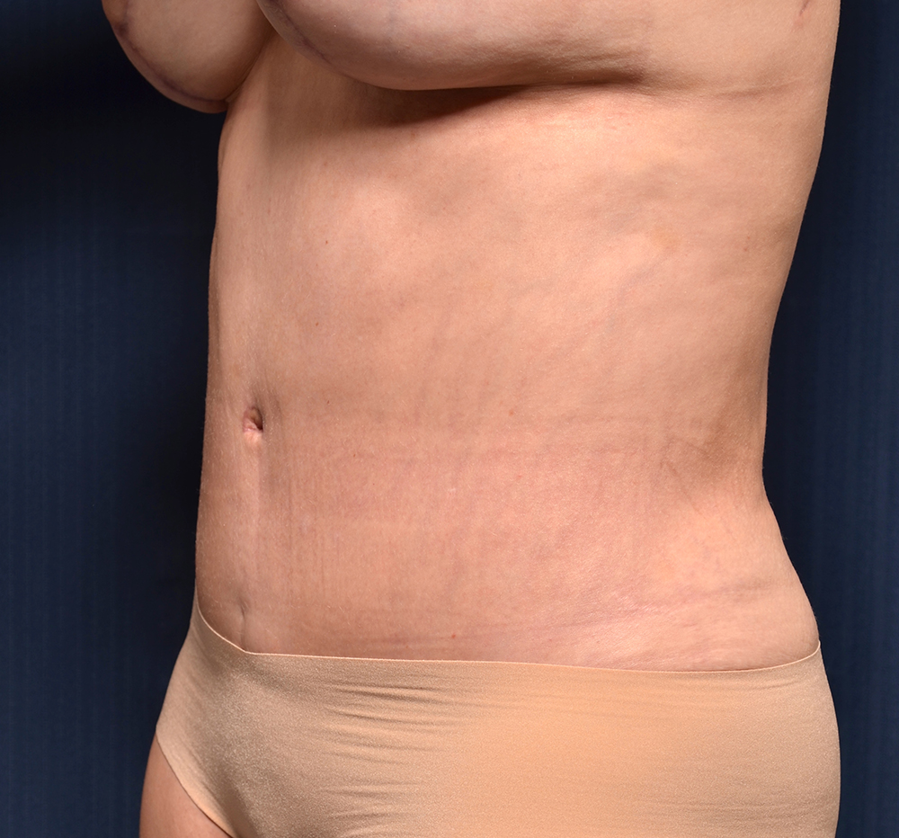 Tummy Tuck