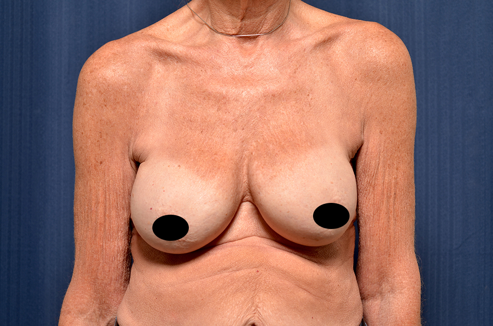 Breast Implant Revision