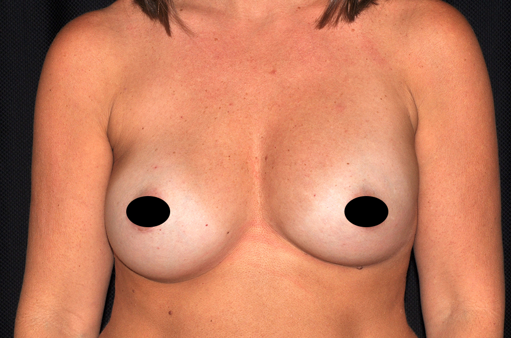 Breast Implant Revision