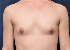Le Spa Plastic Surgery Before and After Photos
