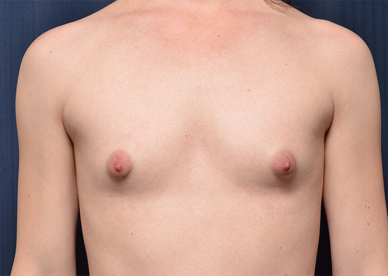 Transition Top Surgery