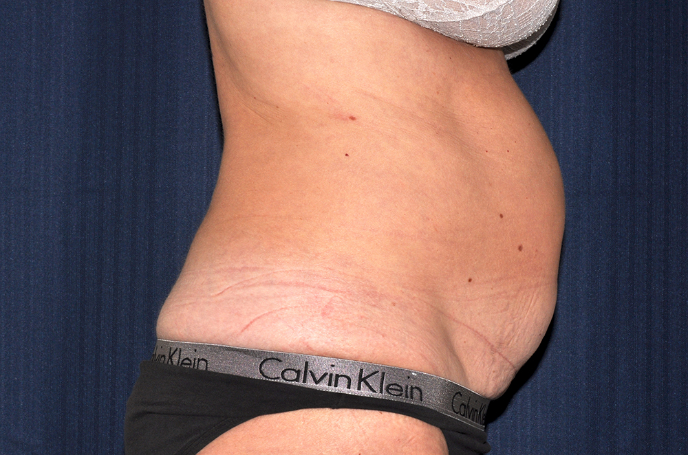 Tummy Tuck