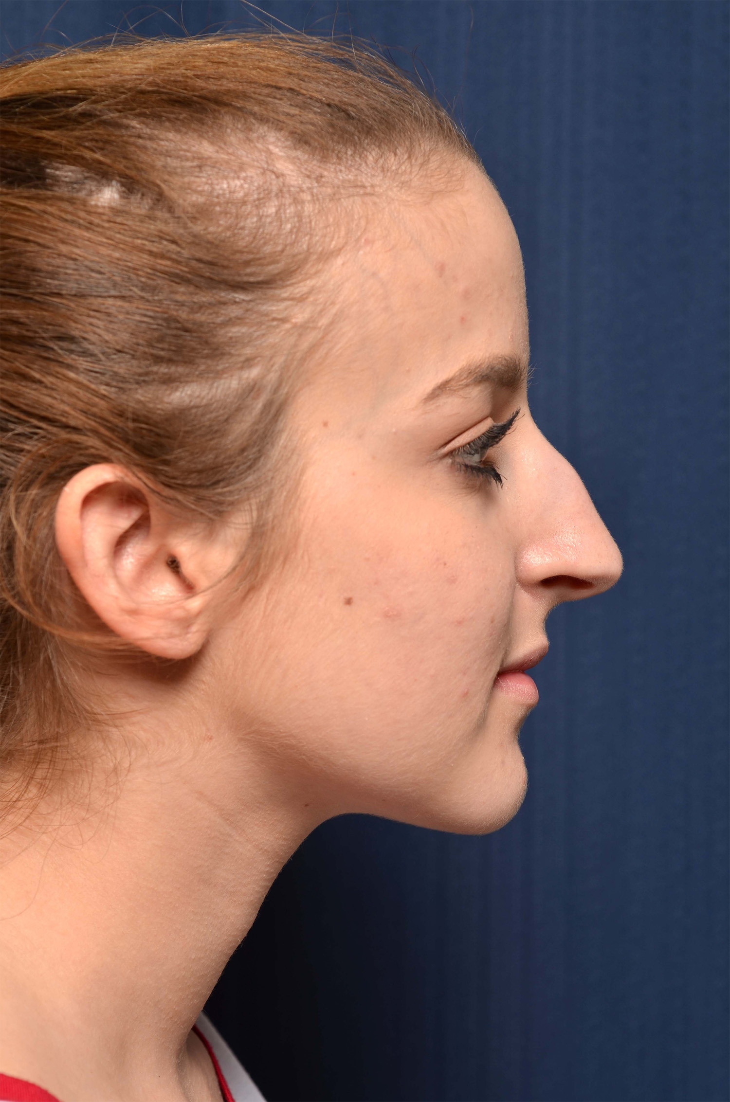 Rhinoplasty