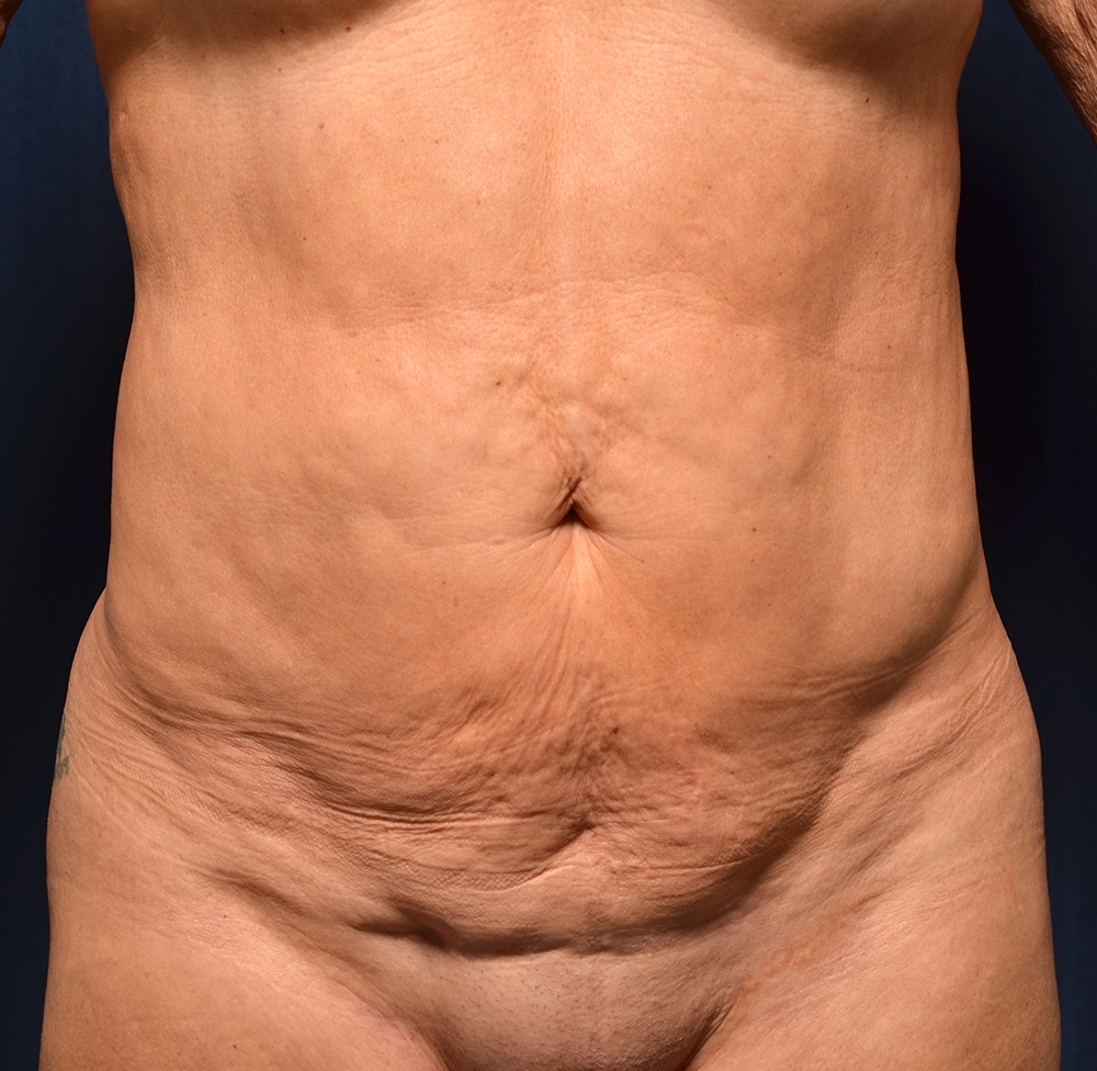 Tummy Tuck