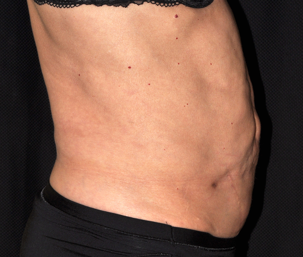 Tummy Tuck