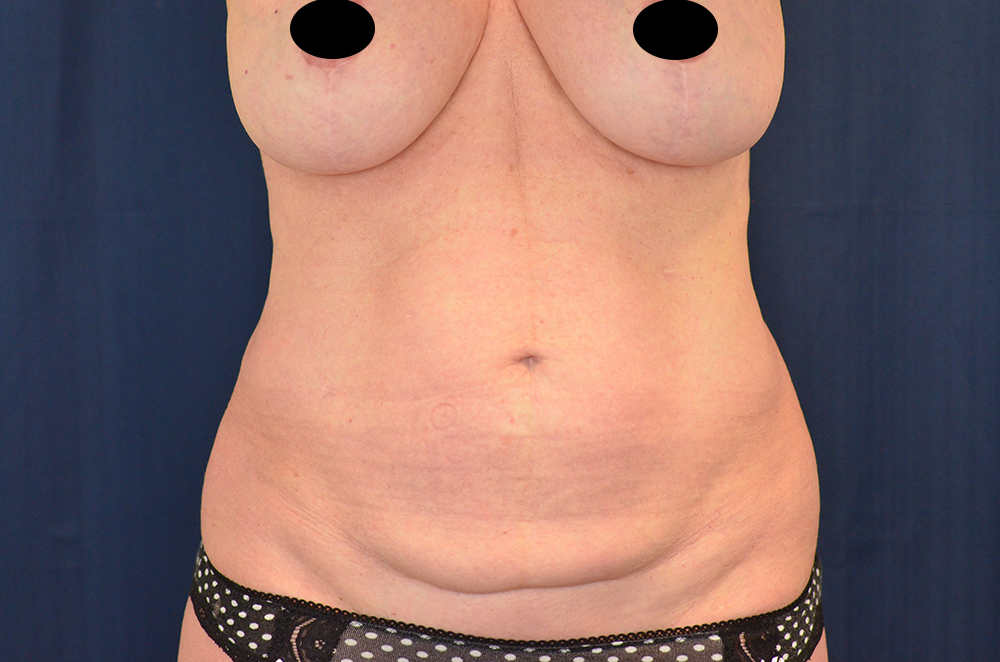 Tummy Tuck