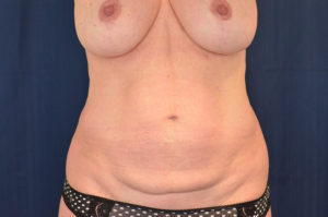 Le Spa Plastic Surgery Before and After Photos
