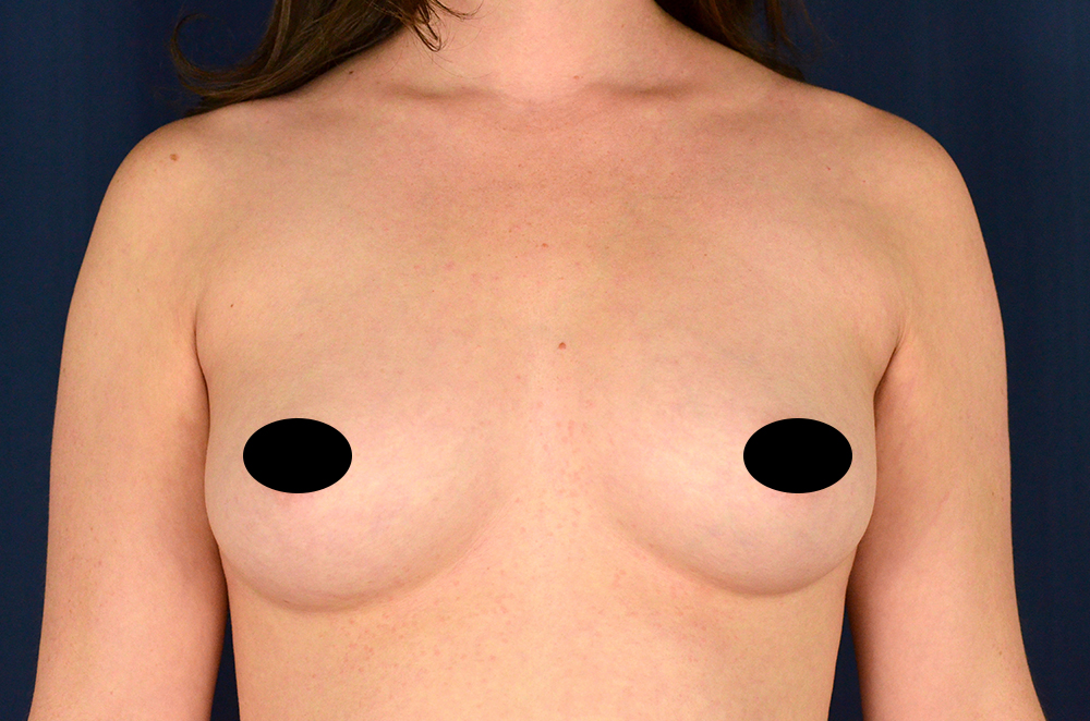 Breast Augmentation