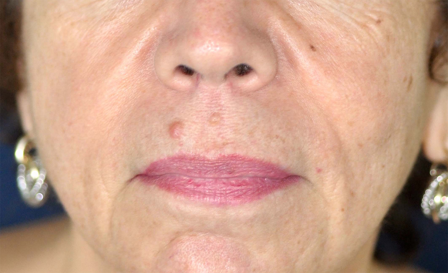 Lip Augmentation / Lip Lift