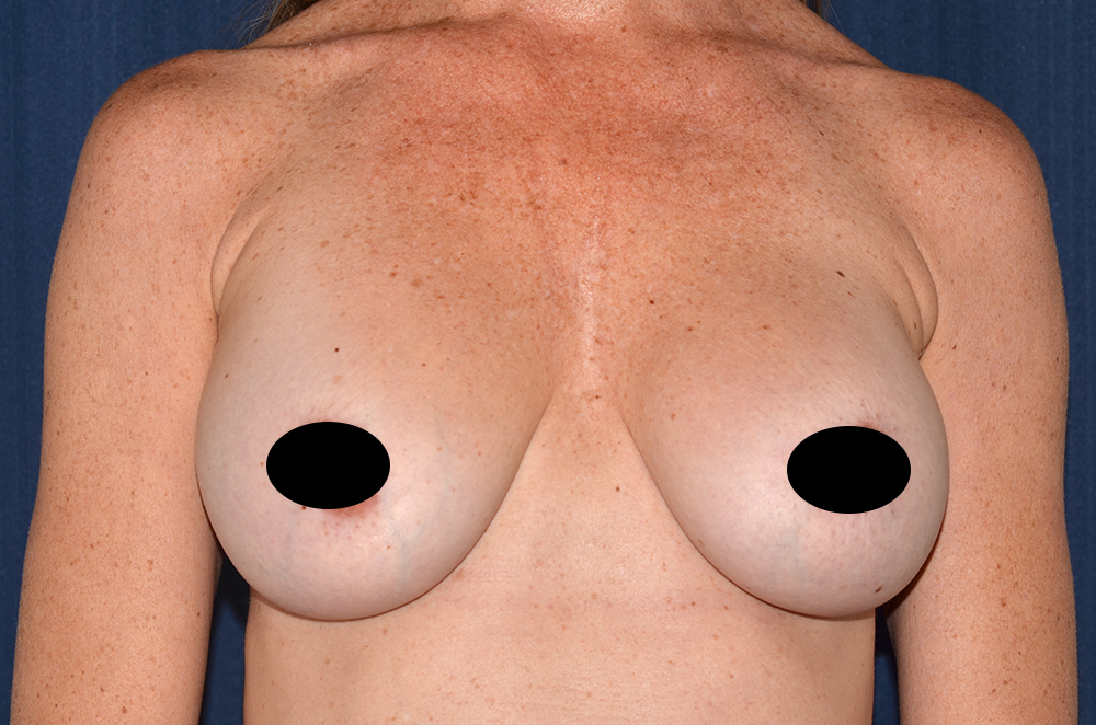 Breast Implant Revision