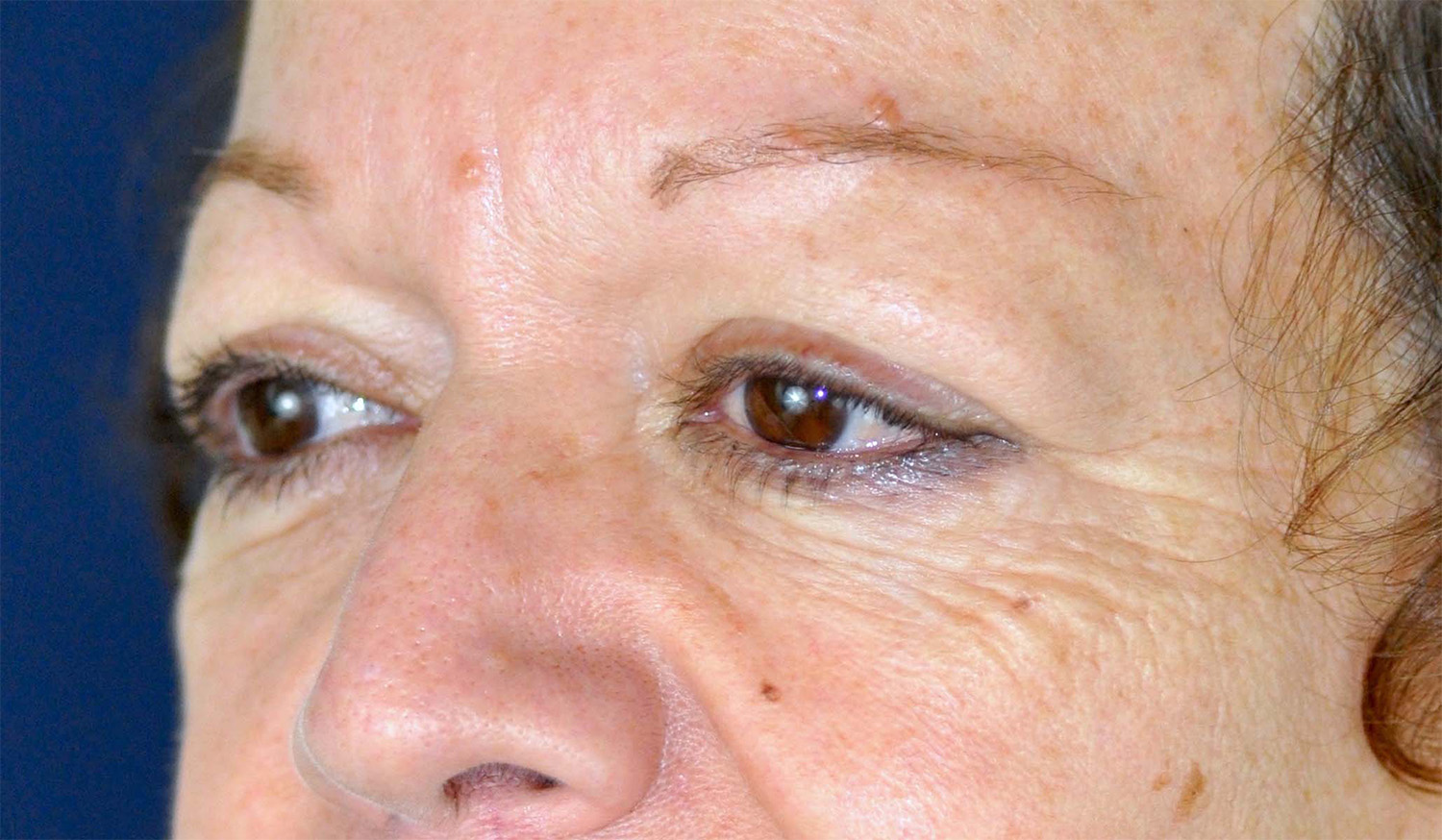 Eyelid Lift / Brow Lift