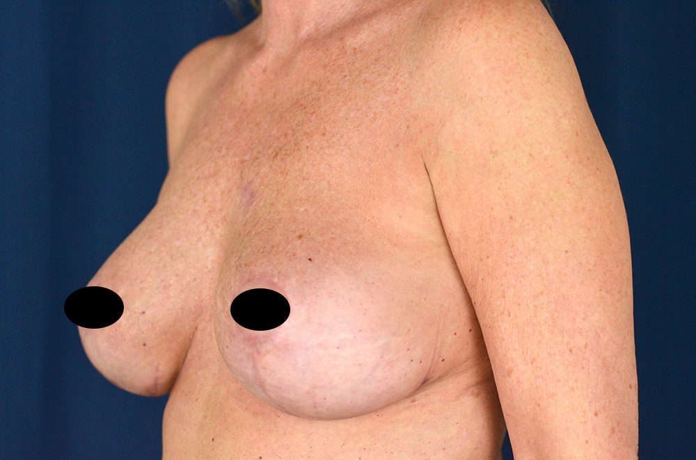 Breast Implant Revision