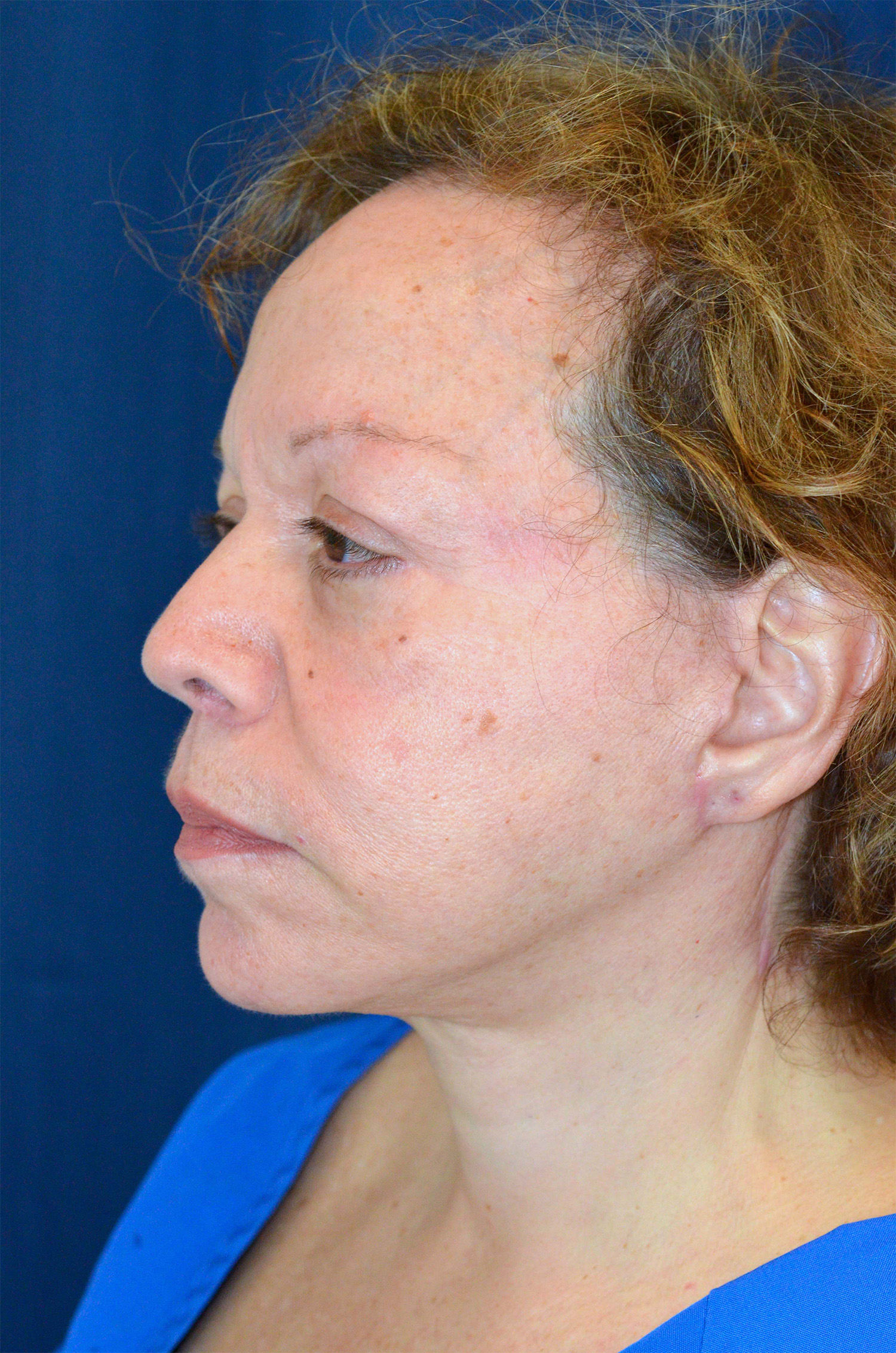 Facelift / Neck Lift