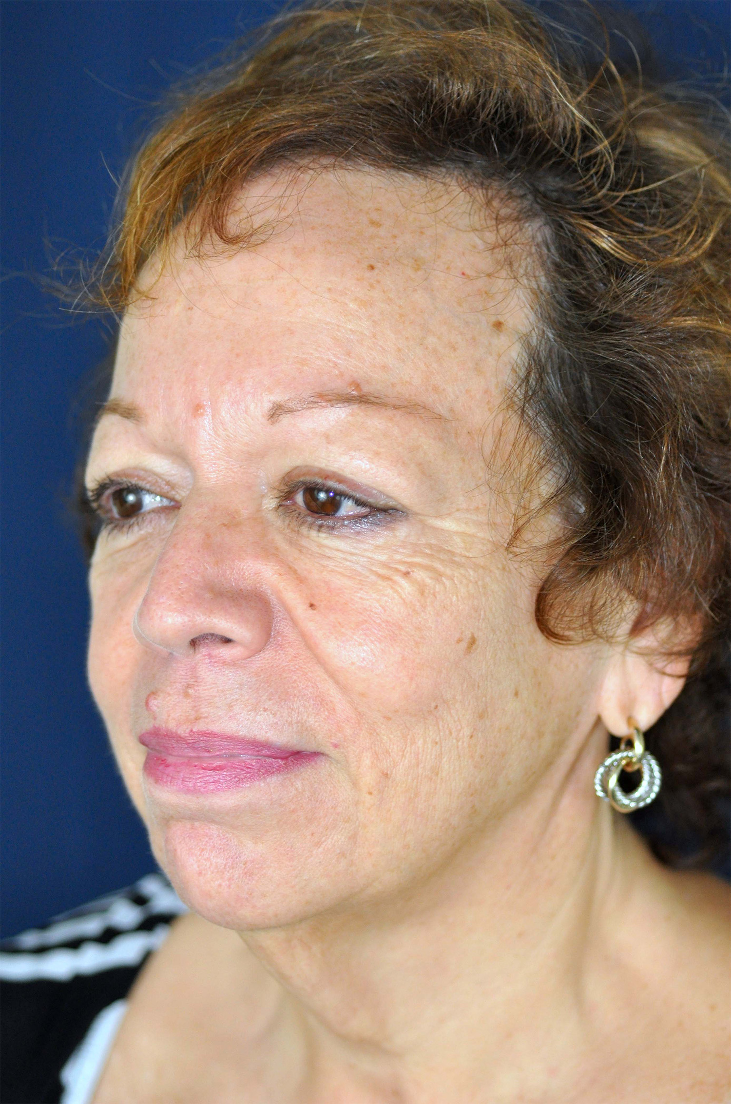 Facelift / Neck Lift