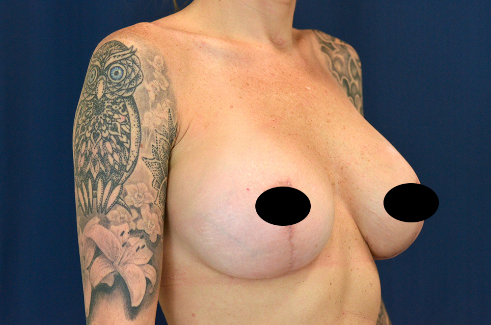 Breast Implant Revision