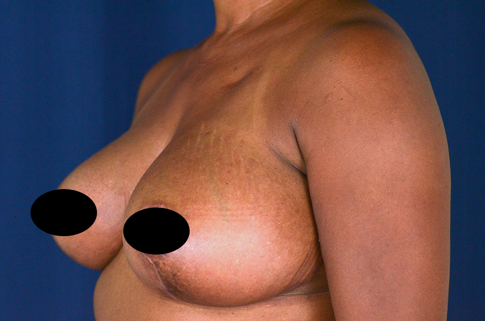 Breast Lift Reduction