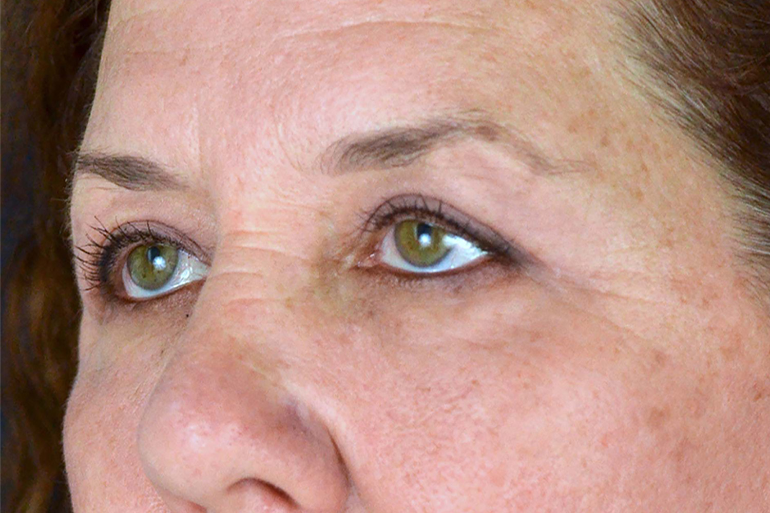 Eyelid Lift / Brow Lift