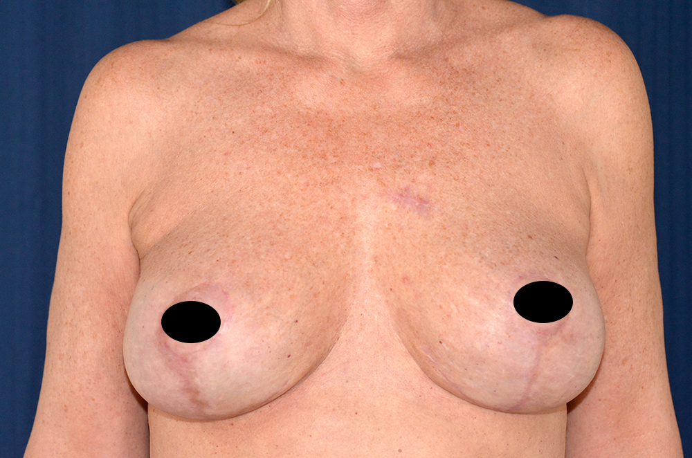 Breast Implant Revision