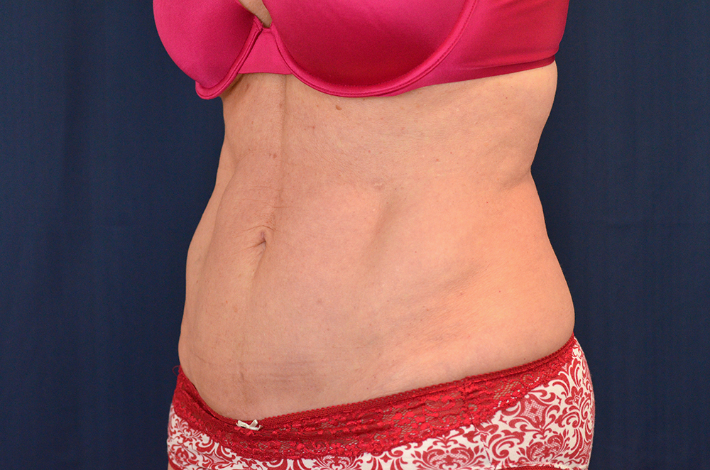 Tummy Tuck