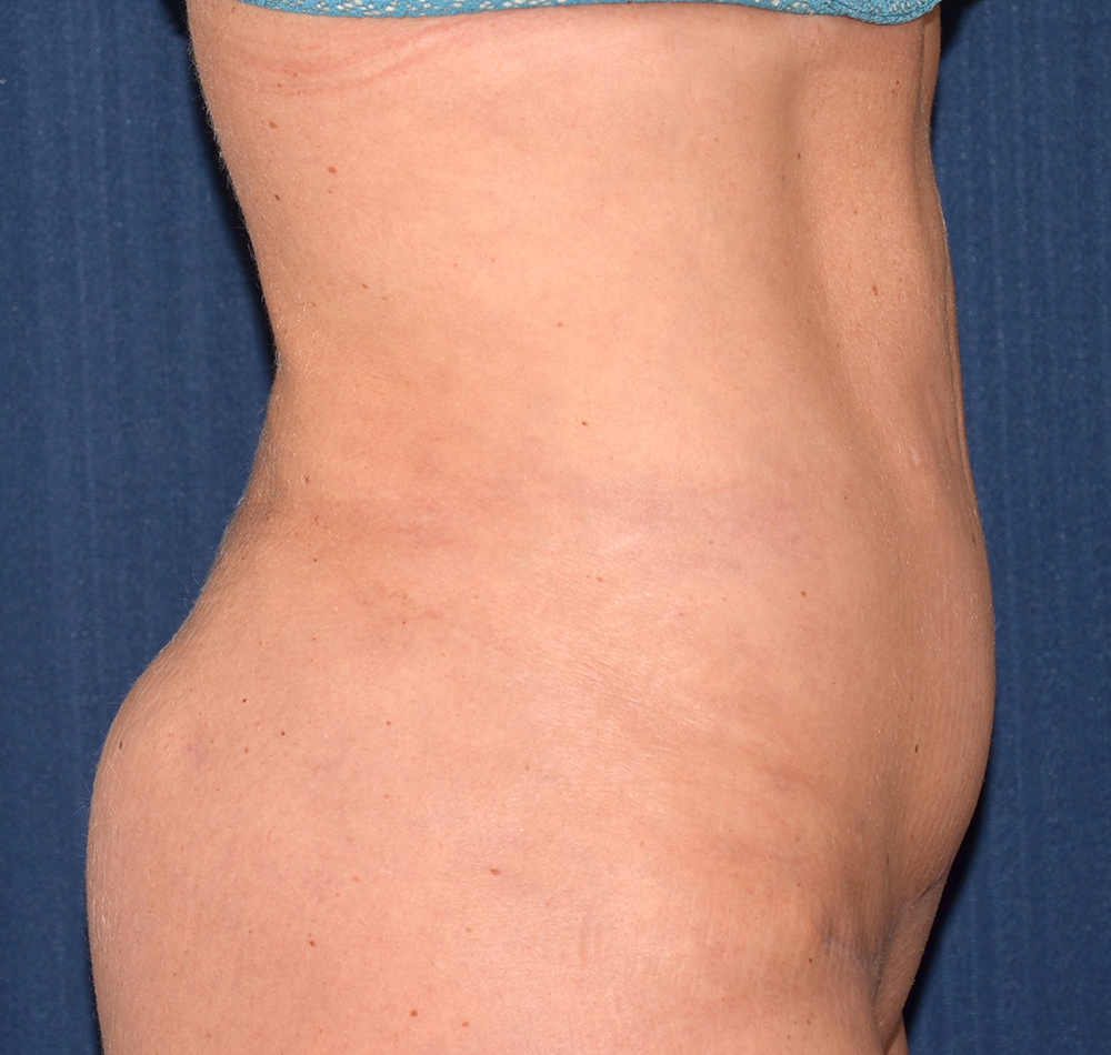 Tummy Tuck