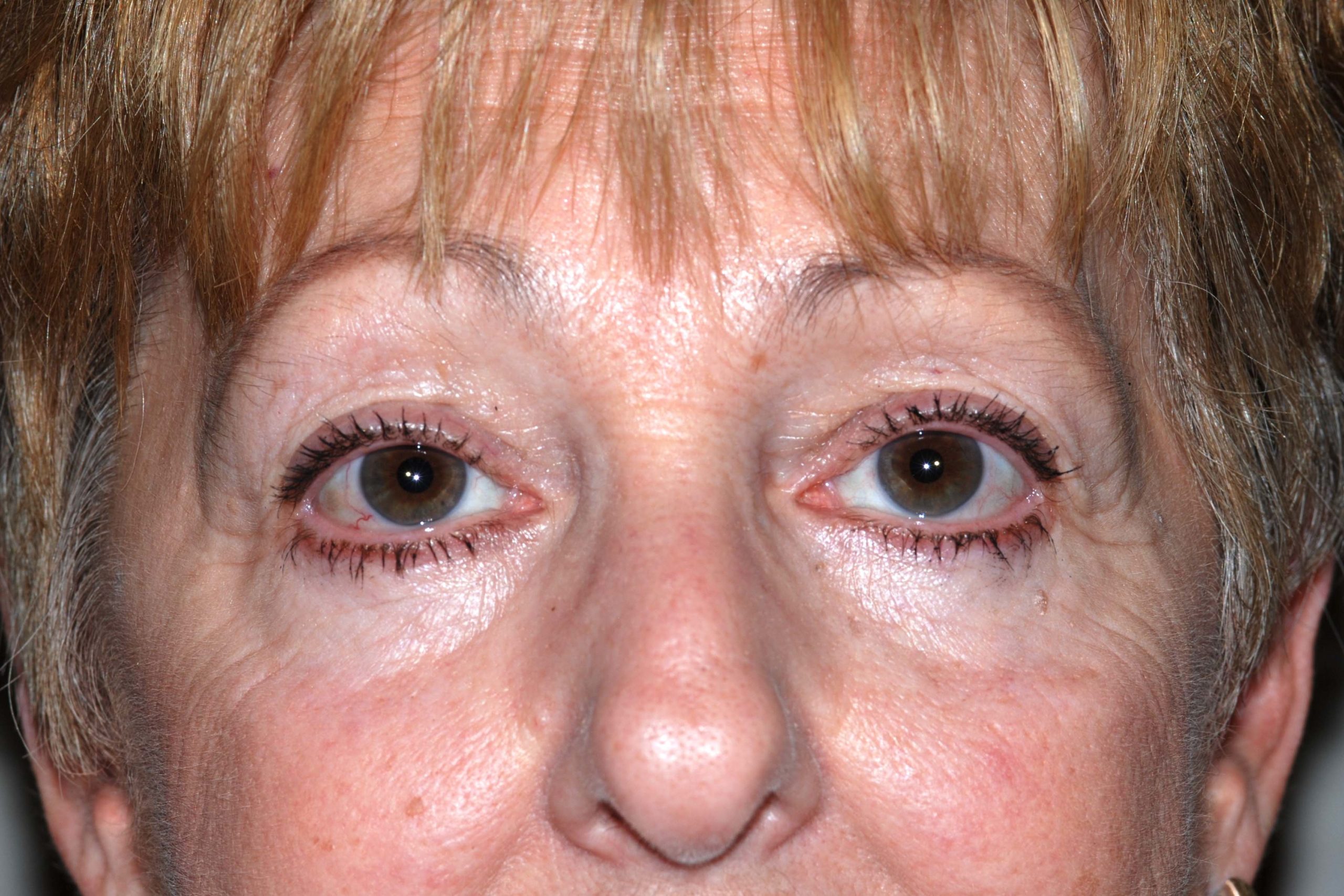 Eyelid Lift / Brow Lift