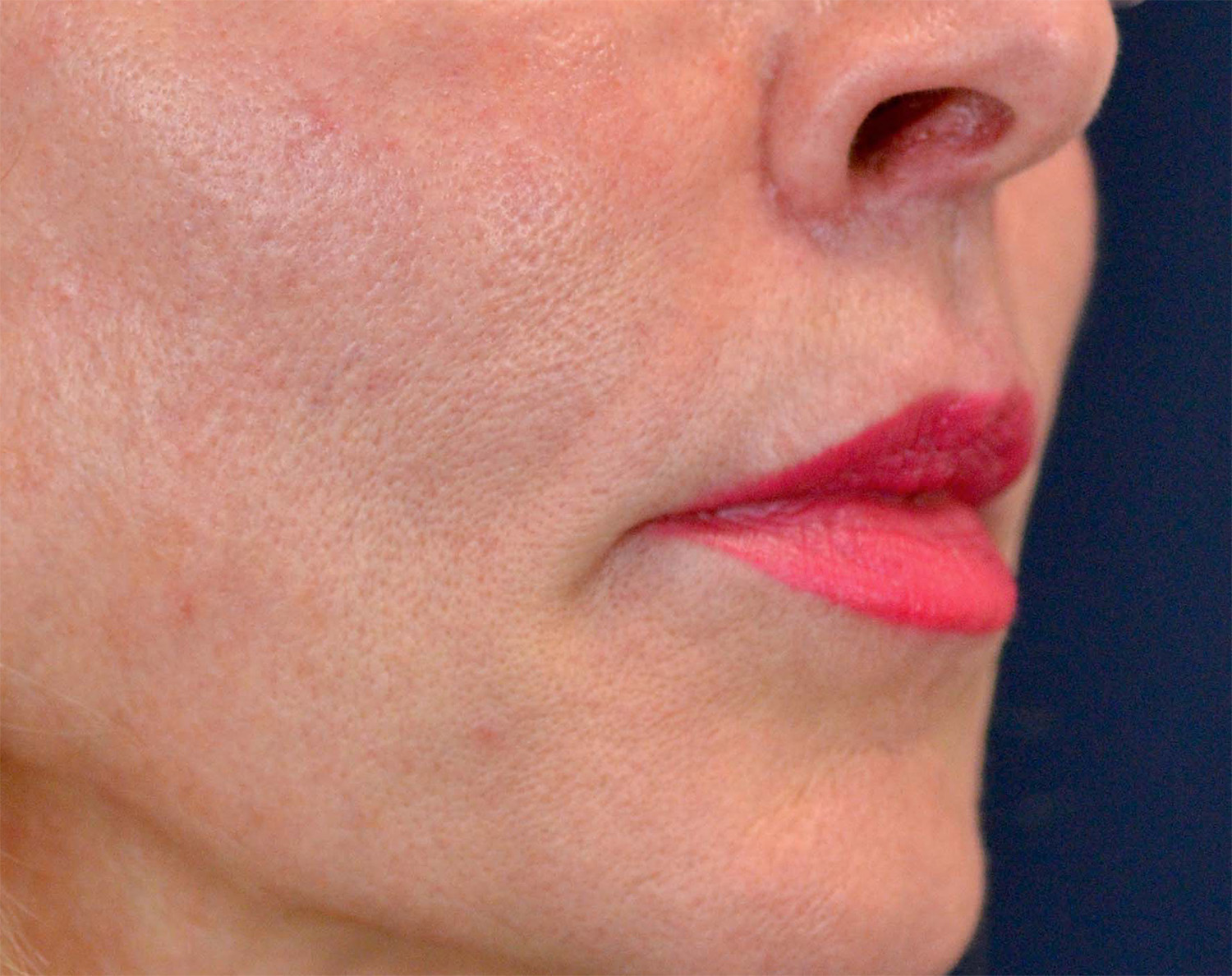 Lip Augmentation / Lip Lift