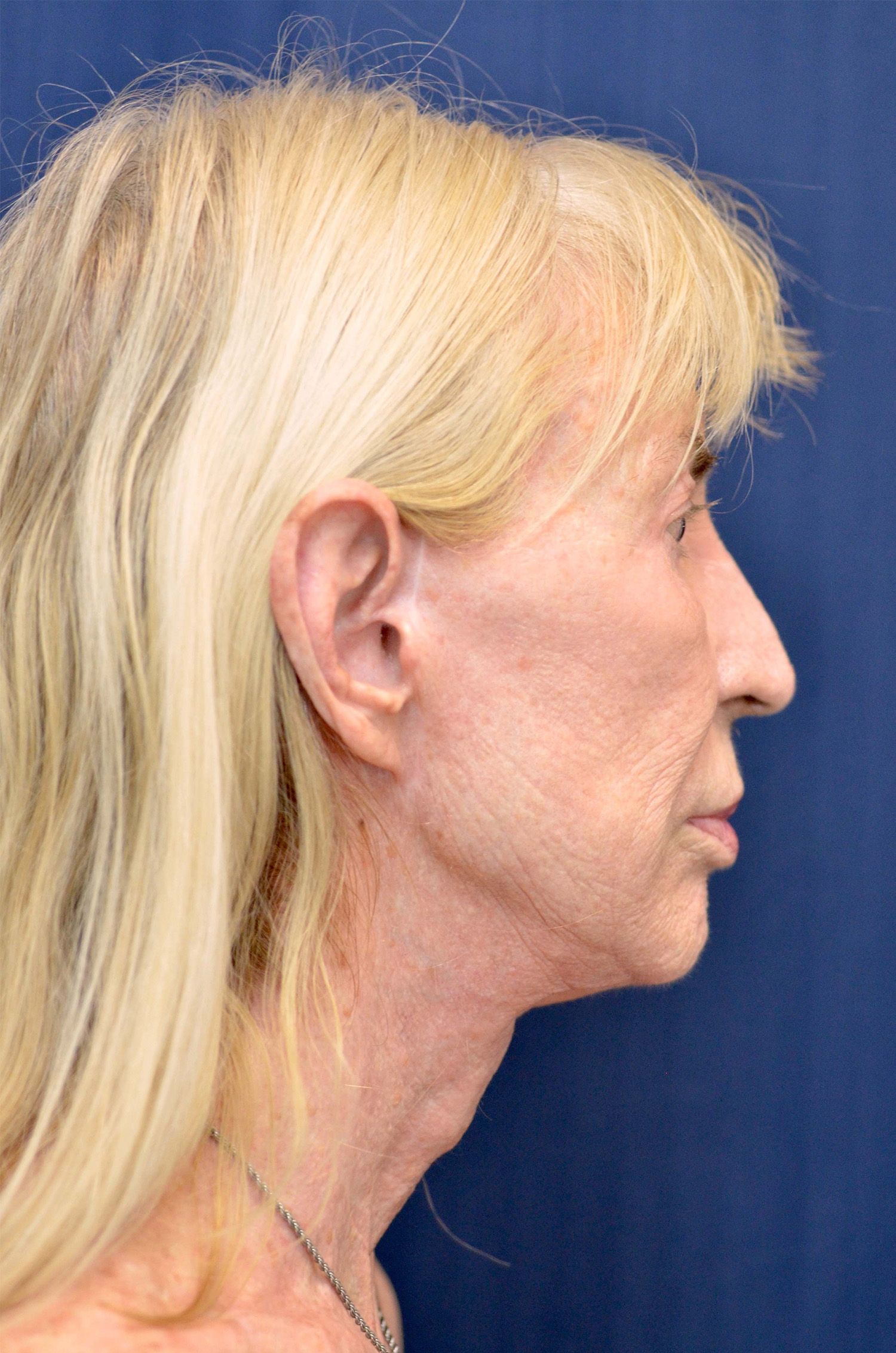 Facelift / Neck Lift