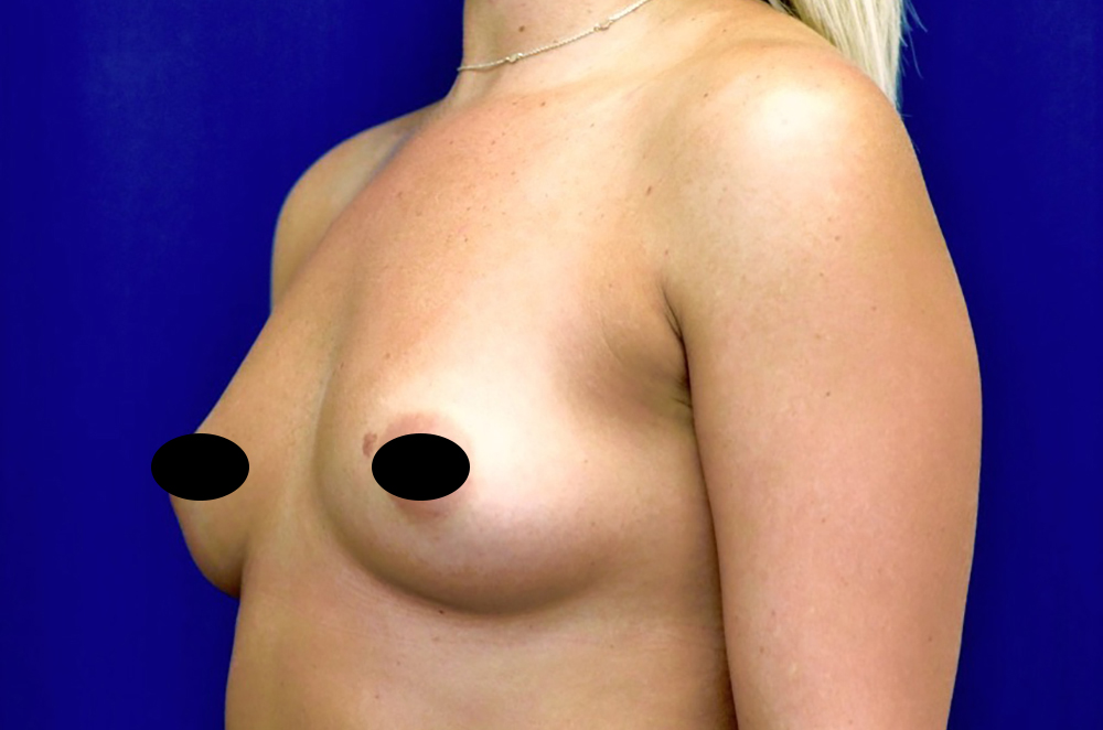 Breast Augmentation