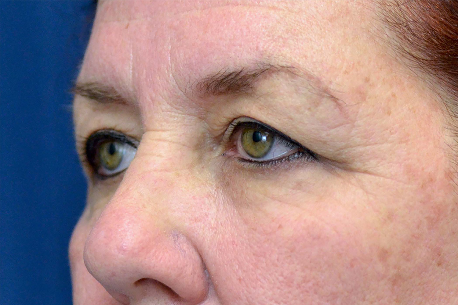 Eyelid Lift / Brow Lift